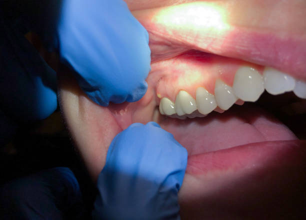 Best Broken or Chipped Tooth Repair in Spanish Fort, AL